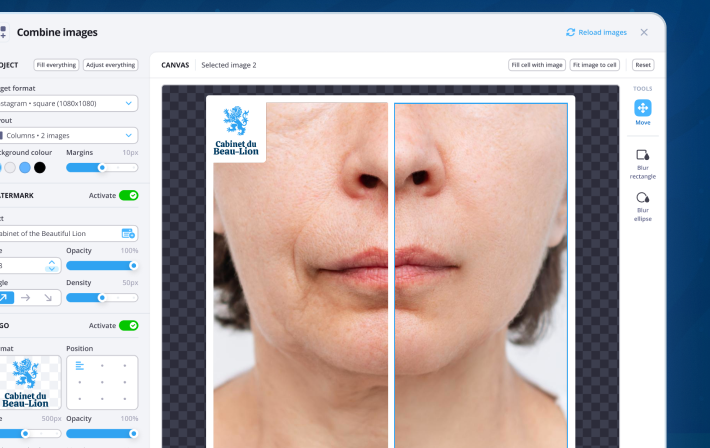 Photos avant/après injections esthétiques